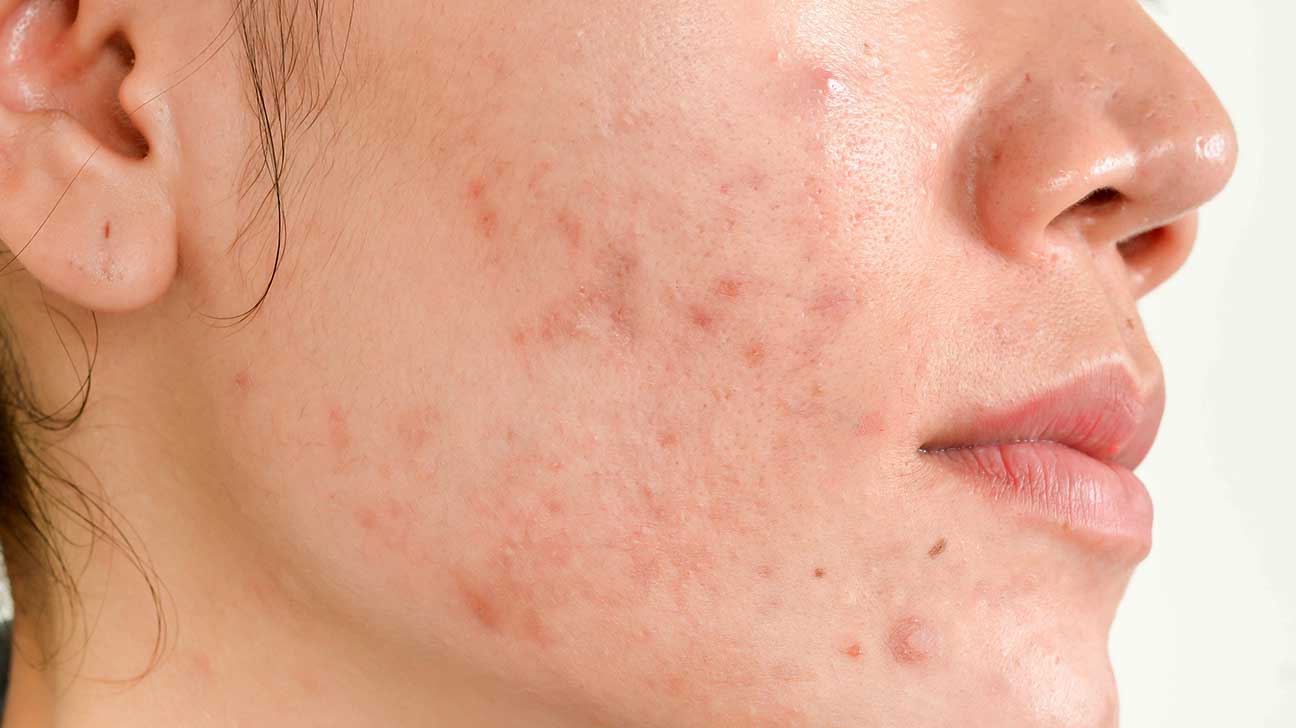 4-things-your-acne-is-really-trying-to-tell-you-endorphitness